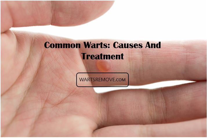 Common Warts: Causes And Treatment