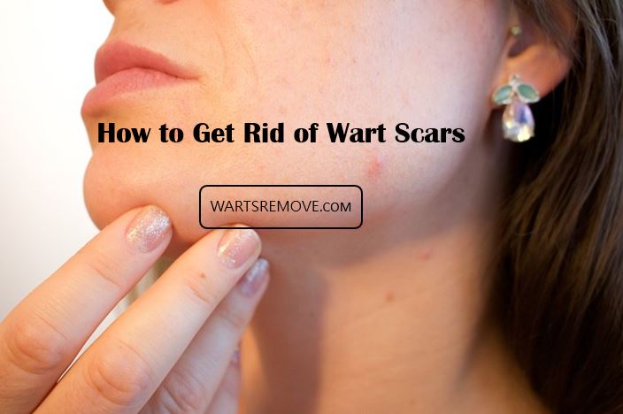 Get rid of wart scars with effective scar removal treatments