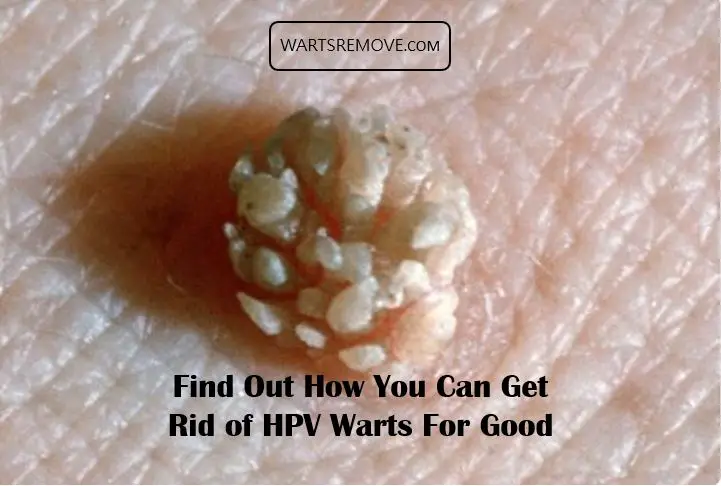 Find Out How You Can Get Rid of HPV Warts For Good