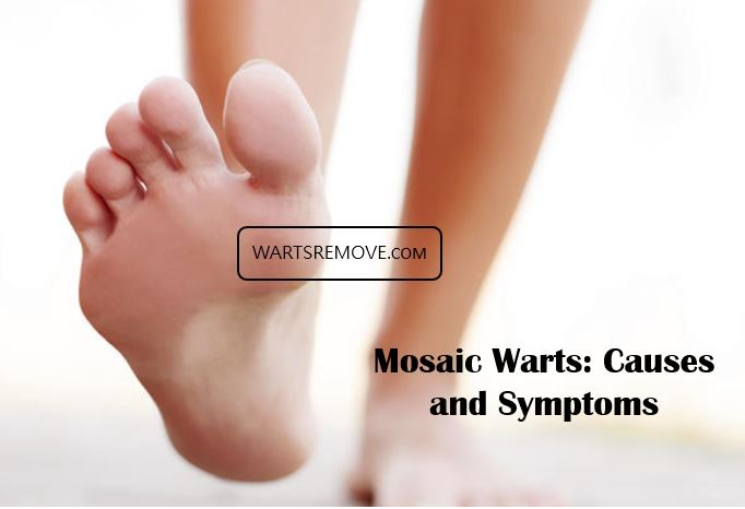 Mosaic Warts: Causes and Symptoms