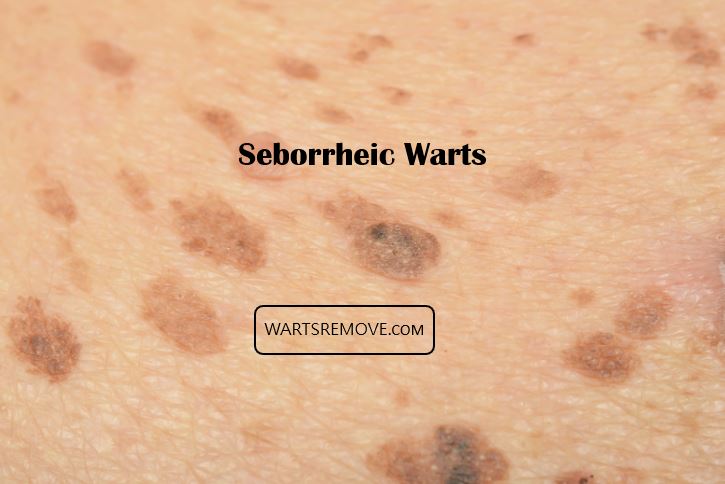 Seborrheic Warts