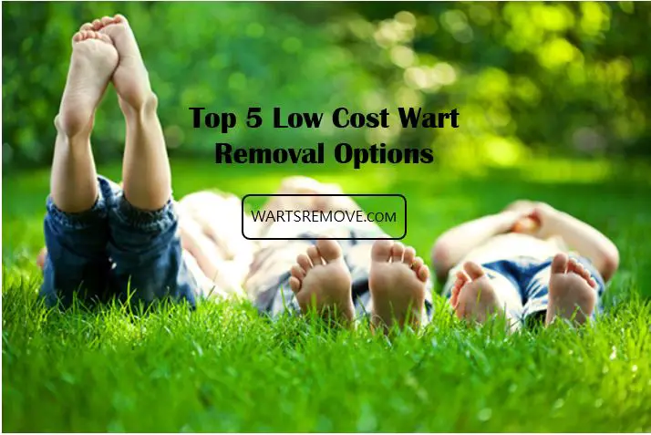 Top 5 Low Cost Wart Removal Options