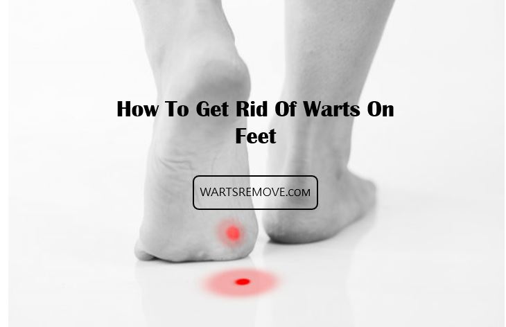 How To Get Rid Of Warts On Feet