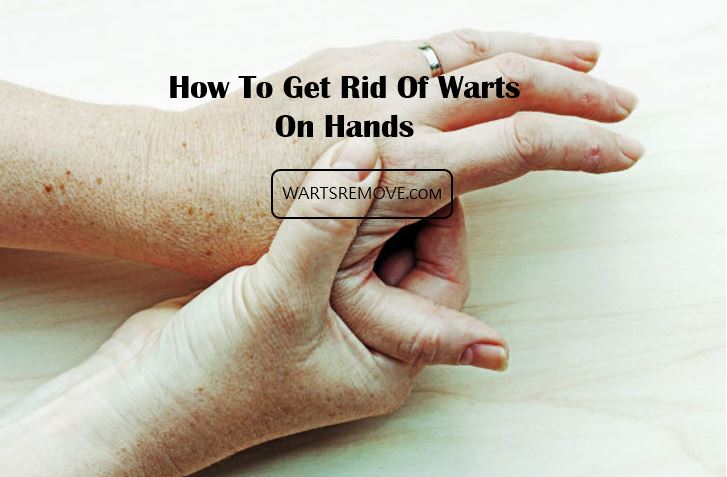 How To Get Rid Of Warts On Hands