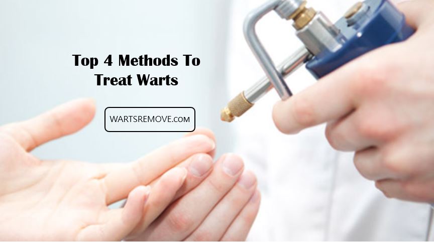 Top 4 Methods To Treat Warts