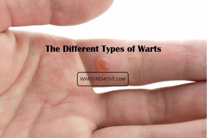 Various types of warts depicted in an image for informational purposes